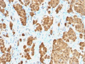 IHC testing of FFPE human melanoma with recombinant S100B antibody. HIER: steam sections in pH 9 10m