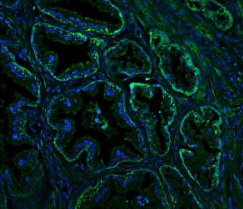 Immunofluorescent staining of FFPE human prostate cancer with Nogo A antibody (green) and DAPI nucle