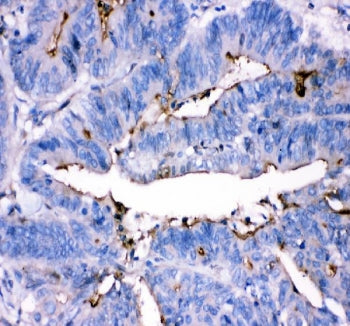 IHC staining of FFPE human intestinal cancer tissue with Adenosine deaminase antibody. HIER: boil ti