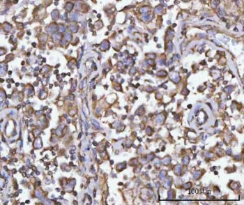 IHC staining of FFPE human testicular seminoma tissue with PFKFB1 antibody. HIER: boil tissue sectio