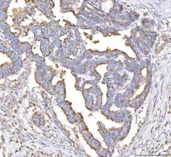 IHC staining of FFPE human cervical cancer tissue with PLP2 antibody. HIER: boil tissue sections in 