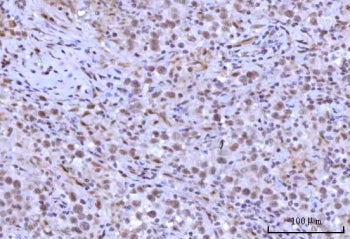 IHC staining of FFPE human testicular seminoma tissue with RNF40 antibody. HIER: boil tissue section