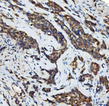 IHC staining of FFPE human lung adenocarcinoma tissue with STK15 antibody. HIER: boil tissue section