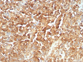 IHC staining of FFPE human melanoma tissue with recombinant NGFR antibody (clone rNGFR/8824). HIER: 