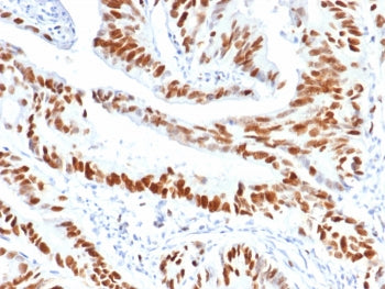 IHC staining of FFPE human colon carcinoma tissue with MCM3 antibody (clone MCM3/6706). HIER: boil t