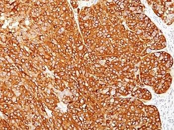 IHC: Formalin-fixed, paraffin-embedded human melanoma stained with melanoma Marker antibody cocktail