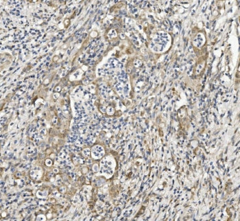 IHC staining of FFPE human rectal cancer with Semaphorin 6A antibody. HIER: boil tissue sections in 