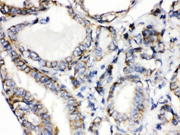 IHC testing of FFPE human thyroid cancer tissue with CGRP antibody. HIER: Boil the paraffin sections