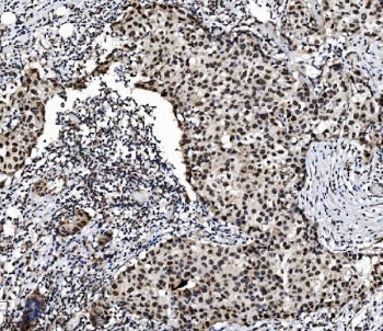 IHC staining of FFPE human breast cancer with PRDM14 antibody. HIER: boil tissue sections in pH8 EDT