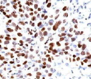 IHC: Formalin-fixed, paraffin-embedded human lung squamous cell carcinoma (SCC) stained with p21 ant