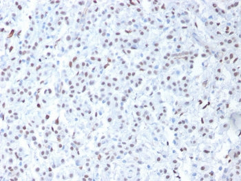 IHC testing of FFPE human mesothelioma with Wilms Tumor 1 antibody (clone 6F-H2). Required HIER: boi