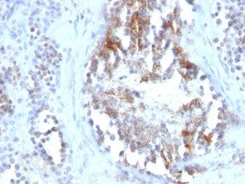 IHC: Formalin-fixed, paraffin-embedded human testicular carcinoma stained with SHBG antibody (clone 