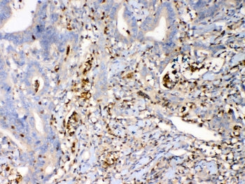 IHC testing of FFPE human rectal cancer tissue with Psoriasin antibody at 1ug/ml. Required HIER: ste