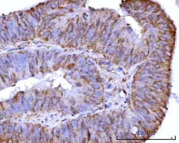 IHC staining of FFPE human colon adenocarcinoma tissue with RPS25 antibody. HIER: boil tissue sectio