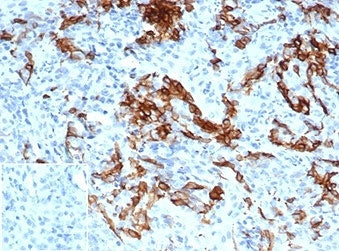 IHC staining of FFPE human melanoma tissue with NGFR/TNFRSF16 antibody (clone NGFR/4919) at 2ug/ml. 