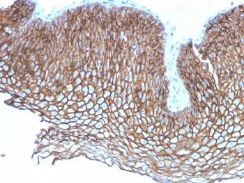 IHC staining of FFPE human esophageal carcinoma with Desmoglein 3 antibody (clone DSG3/2837). HIER: 