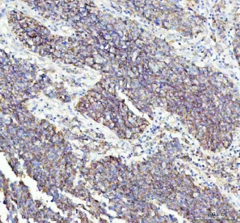 IHC staining of FFPE human lung squamous cell carcinoma tissue with FLOT1 antibody. HIER: boil tissu