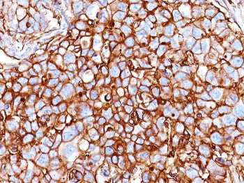 IHC: Formalin-fixed, paraffin-embedded human breast carcinoma stained with CD44 antibody (clone HCAM