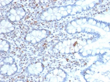 IHC testing of FFPE human colon carcinoma with BMI1 antibody (clone BMI1/2689). HIER: boil tissue se