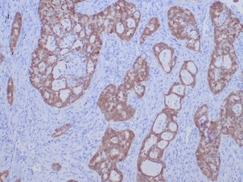 IHC staining of FFPE human lung carcinoma tissue with ROS1 antibody (clone ROS1/7999R). HIER: boil t