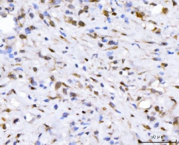 IHC staining of FFPE human gastric cancer tissue with Fibroblast Growth Factor 2 antibody. HIER: boi