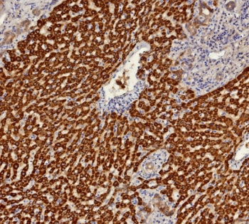 IHC staining of FFPE human hepatocellular carcinoma tissue with AKR1C1 antibody (clone AKR1C1/9314).