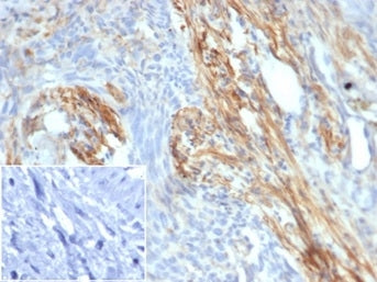 IHC staining of FFPE human bladder carcinoma tissue with PIK3 antibody (clone PIK3R2/292). Negative 