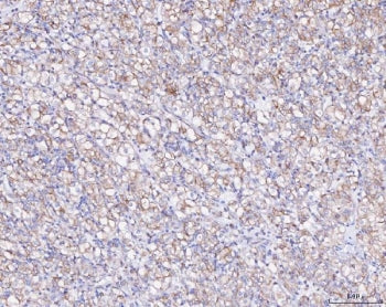 IHC staining of FFPE human glioma tissue with ATX2 antibody. HIER: boil tissue sections in pH8 EDTA 