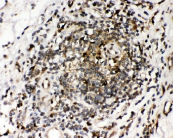 IHC staining of FFPE human intestinal cancer tissue with Ribonuclease Inhibitor antibody. HIER: boil