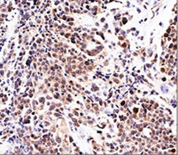 IHC testing of FFPE urinary transitional cell carcinoma with p21 antibody (clone WA-1). Required HIE