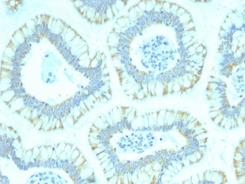 IHC staining of FFPE human colon carcinoma with SMAD4 antibody (clone SMAD4/2440). HIER: boil tissue