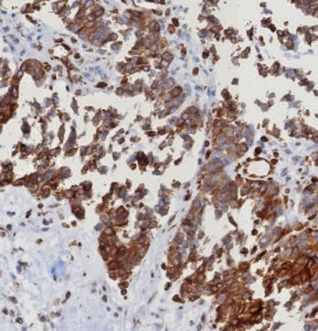 IHC staining of FFPE human serous ovarian carcinoma with ERIS antibody (clone STING1/8187R). HIER: b