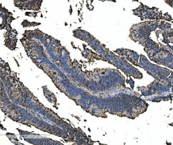 IHC staining of FFPE human rectal cancer tissue with Astrin antibody. HIER: boil tissue sections in 