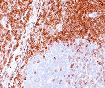 IHC testing of formalin-paraffin non-Hodgkin's lymphoma stained with Bcl-2 antibody (100/D5). Note n