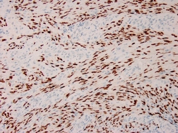 IHC staining of FFPE human Karposi's sarcoma with recombinant HHV8 antibody. HIER: boil tissue secti