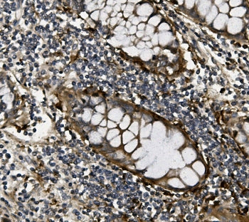 IHC staining of FFPE human rectal cancer with VEGF antibody. HIER: boil tissue sections in pH6, 10mM