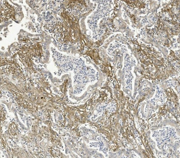 IHC staining of FFPE human rectal cancer with ITGB5 antibody. HIER: boil tissue sections in pH8 EDTA