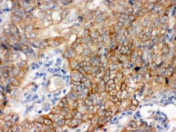 IHC testing of FFPE human lung cancer tissue with BAG3 antibody. HIER: Boil the paraffin sections in