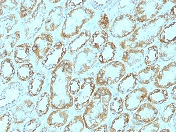 IHC: Formalin-fixed, paraffin-embedded human renal cell carcinoma stained with Laminin gamma 1 antib