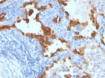 IHC staining of FFPE human lung carcinoma tissue with Cytokeratin 8/18 antibody (clone SPM192 + SPM2