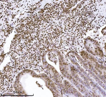 IHC staining of FFPE human colorectal adenocarcinoma tissue with KPNB1 antibody. HIER: boil tissue s