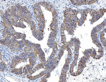 IHC staining of FFPE human endometrial cancer tissue with Poliovirus Receptor antibody. HIER: boil t