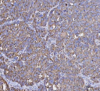 IHC staining of FFPE human ovarian carcinoma tissue with MUC1 antibody. HIER: boil tissue sections i