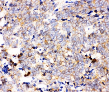IHC staining of FFPE human lung cancer tissue with IKK alpha antibody. HIER: boil tissue sections in
