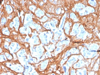 IHC staining of FFPE human colon carcinoma with Periostin antibody (clone POSTN/3503). HIER: boil ti