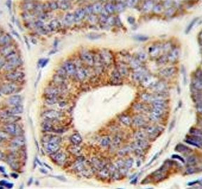 IHC testing of FFPE human prostate carcinoma tissue with DNAJA1 antibody. HIER: steam section in pH6