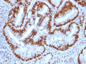 IHC staining of FFPE human endometrial carcinoma with Estrogen Receptor alpha antibody (clone 1D5). 