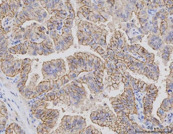 IHC staining of FFPE human lung adenocarcinoma tissue with CLDN3 antibody. HIER: boil tissue section