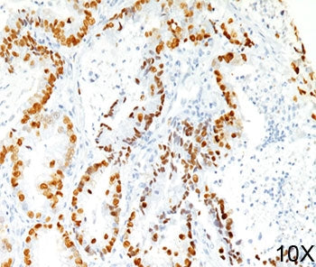 IHC staining of human lung adenocarcinoma (10X) with TTF-1 antibody (8G7G3/1).