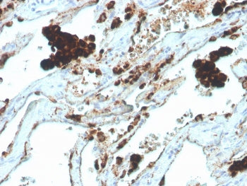 IHC staining of FFPE human lung adenocarcinoma with recombinant Napsin A antibody (clone NAPSA/4400R